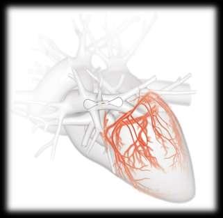 Hemodynamic-Guided HF Management Cardiomems HF System Pulmonary Artery Pressure Sensor Target location for
