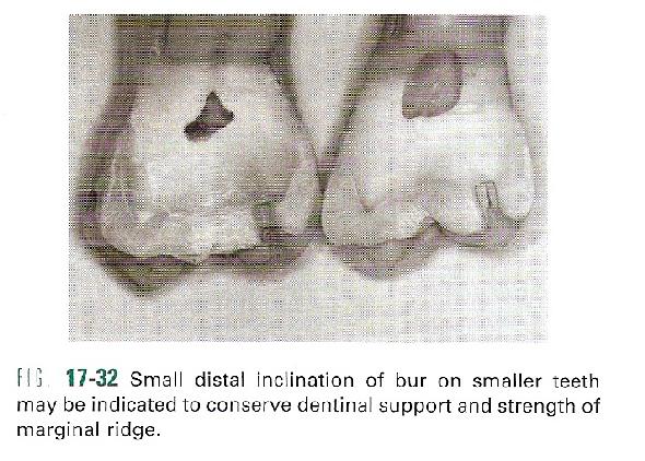 Initial Clinical Procedures. Tooth Preparation. The initial tooth preparation involves the establishment of the outline, primary resistance, primary retention forms, and initial preparation depth.