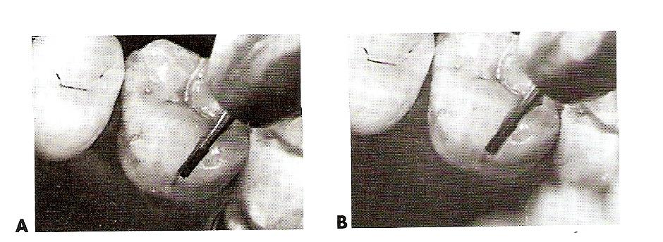 This depth the pulpal floor is usually in dentin. Once the entry cut is made (see Fig.