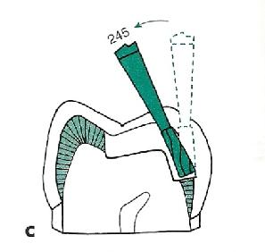 At the same depth, move the bur along the fissure toward the lingual surface (see Fig. 17-34, E).