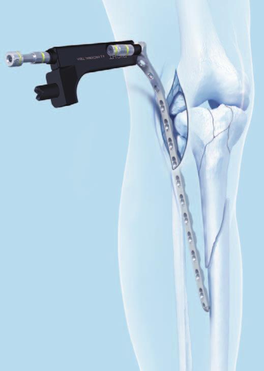 Surgical Technique 5 Insert plate Using the insertion handle assembly, insert the plate submuscularly proximal-to-distal, starting at the tibial plateau.