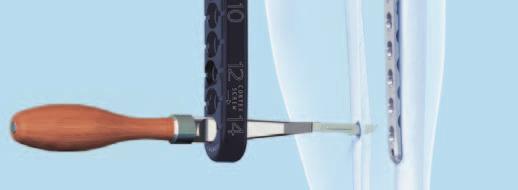 0, percutaneous, for Guide Wire 2.5 mm Attach the appropriate aiming arm by tightening its connecting bolt firmly into the insertion handle.