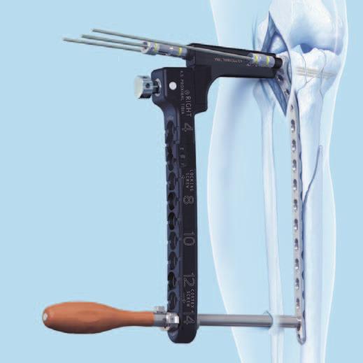 Insert the trocar with handle into a guide sleeve for periarticular aiming arm