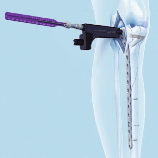 Surgical Technique 15 Insert central cannulated locking screw 5.0 mm in plate head Instruments 314.050 Screwdriver, hexagonal, cannulated, for Cannulated Screws 6.5 and 7.3 mm 314.