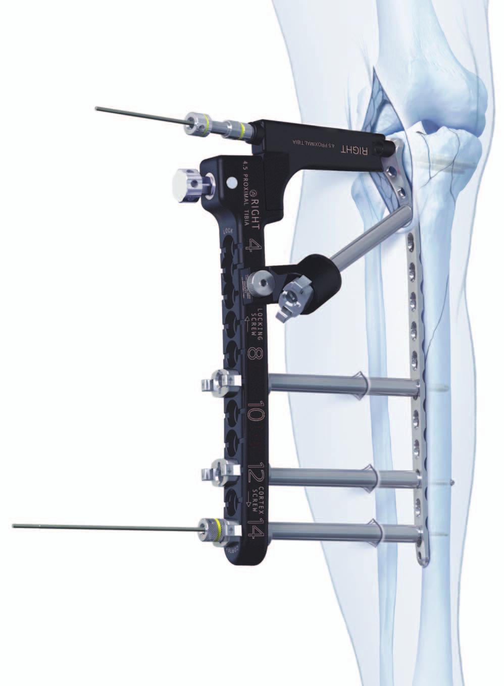 Periarticular Aiming Arm Instruments for LCP Proximal Tibial Plate 4.5/5.0. Part of the LCP Periarticular Aiming Arm Instrument System (large).