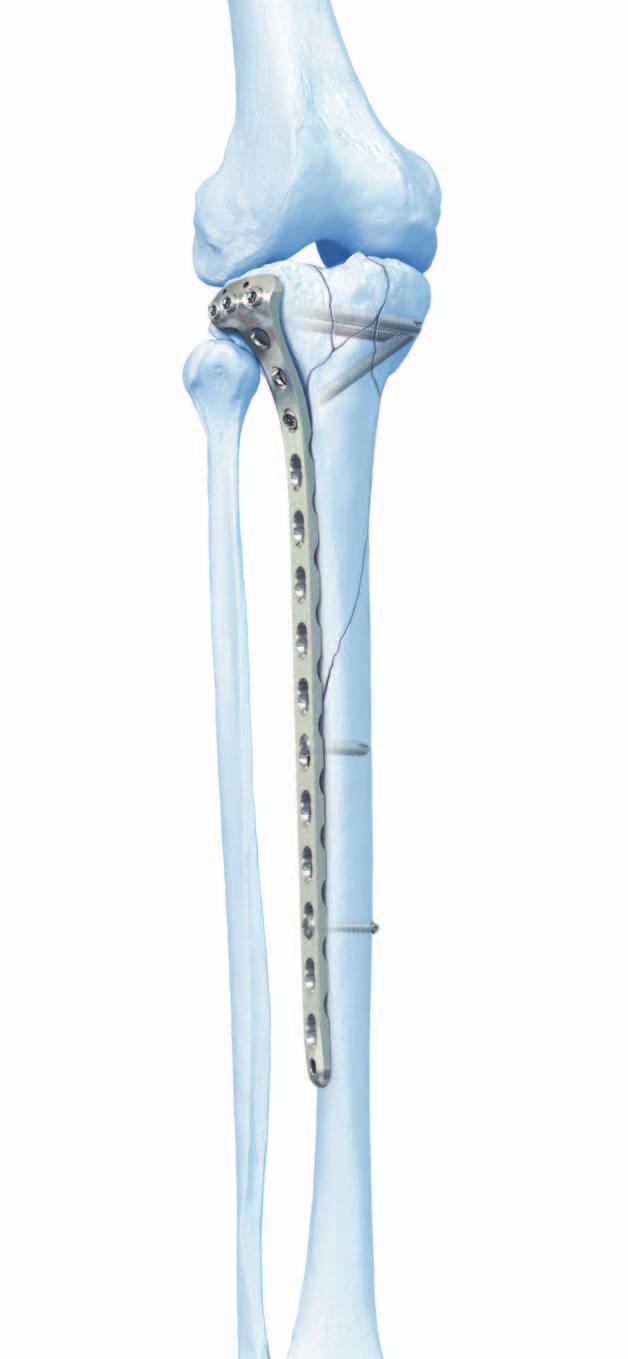 LCP Proximal Tibial Plate 4.5/5.0 The Synthes LCP Proximal Tibial Plate 4.5/5.0 is part of the LCP Periarticular Plating System, which merges locking screw technology with conventional plating techniques.