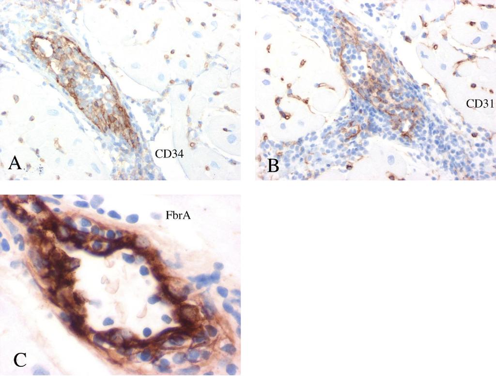 (B) CD4 immunohistochemical staining shows T lymphocytes infiltrating the vessel wall. (C) CD68 immunohistochemical staining shows a minor subpopulation of macrophages in the infiltrate.