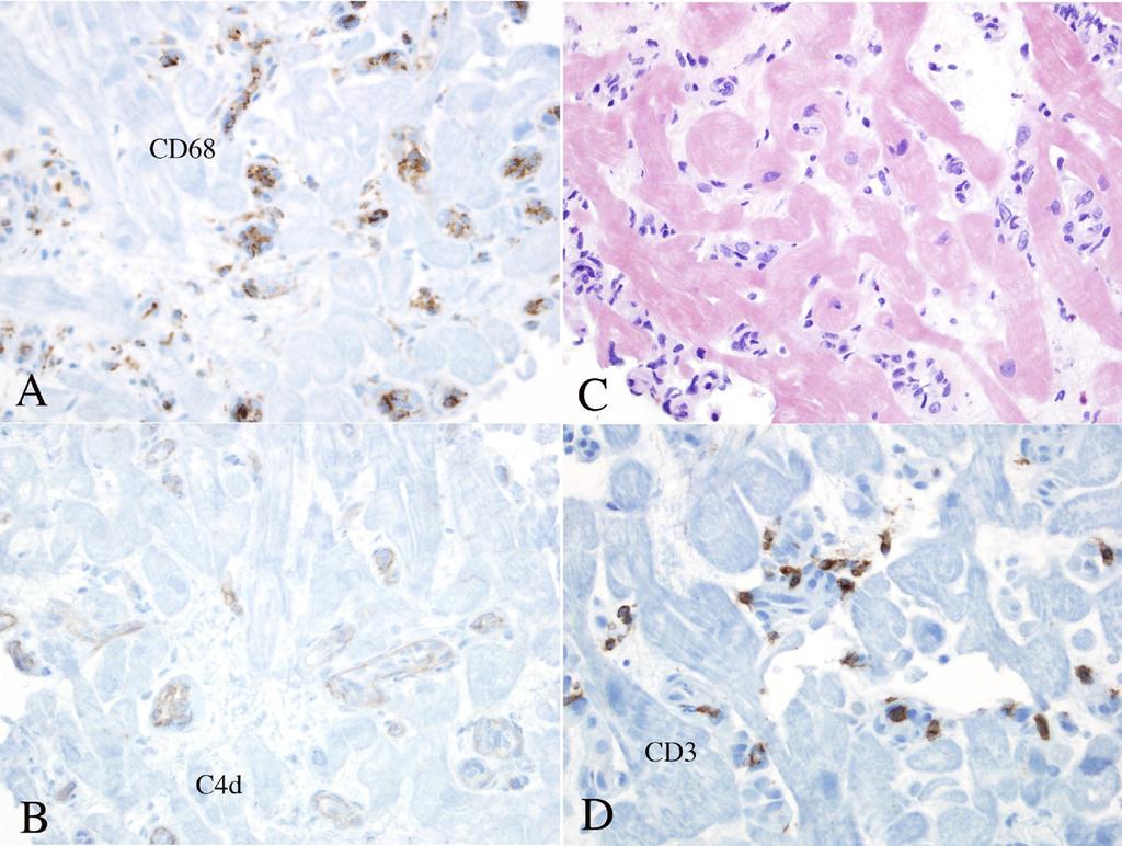 6 The Journal of Heart and Lung Transplantation, Vol xx, No x, Month 2011 Figure 5 (A) Capillaries and small arterioles are expanded and filled with CD68-positive macrophages with (B) diffuse