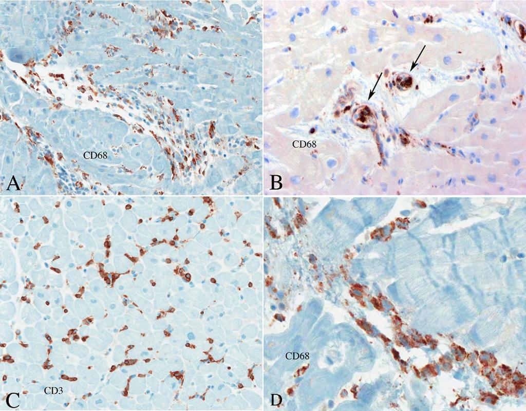 Tavora et al. Endothelitis and Antibody Mediated Rejection 7 Figure 6 Perivascular inflammation associated with endothelitis in a patient with clinical antibody-mediated rejection.