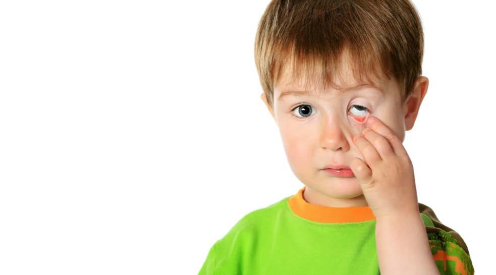 Leading Causes of Visual Impairment Infants, Toddlers,