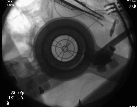 IntraoperaIve Fluoroscopy Fiducials a=ached to