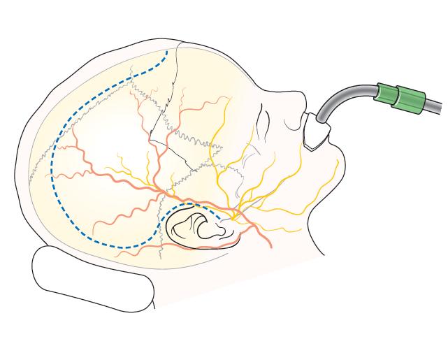 Diffuse brain injury Bi-coronal scalp flap Bilateral frontal craniectomy