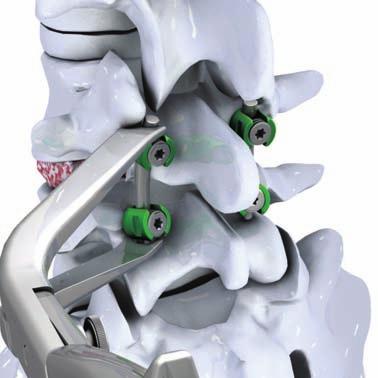combined with a posterior fusion system, such as the ODALYS system.