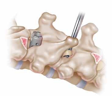 The fourth possible site is the inferior lamina. The Angled Blade Hook is recommended for this site in the lumbar spine.