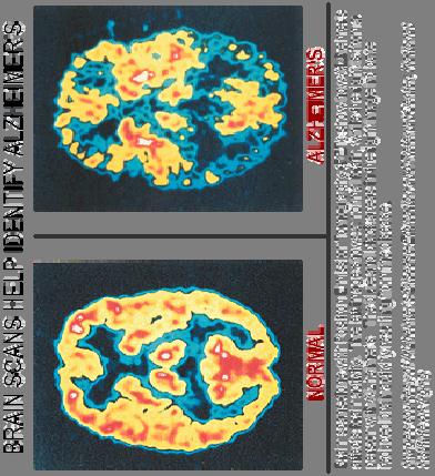 Diagnosing MCI: Neuroimaging PET scan may be useful to distinguish frontotemporal dementia from Alzheimer s disease, but is not covered by