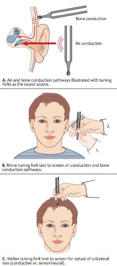 How to: Examine the ears Tuning fork assessment 512 Hz TF Subjectively compare both ears (ID if one ear is clearly better hearing) OTOLARYNGOLOGY CONSULT Weber (on the forehead or