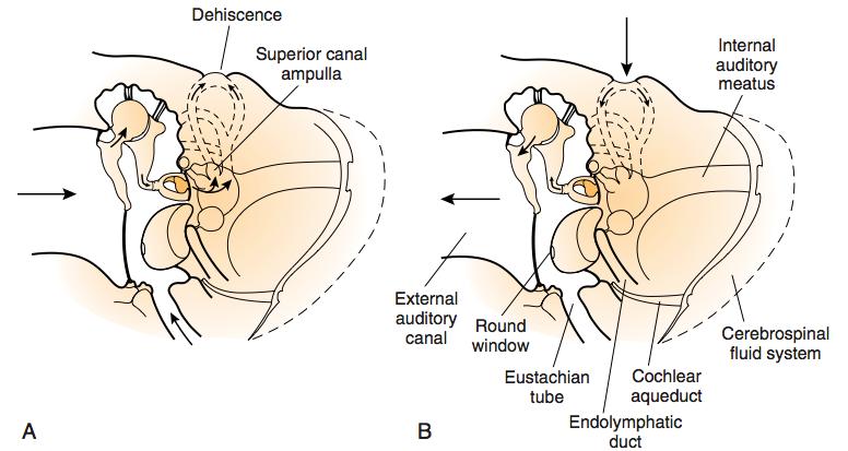 Superior semicircular canal dehiscence