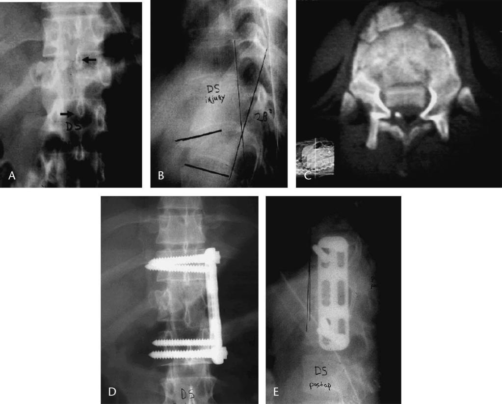 Sasso et al J Spinal Disord Tech Volume 18, Supplement 1, February 2005 classification system) as a single-stage, stand-alone anterior procedure with recent-generation anterior instrumentation.