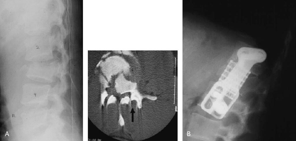 J Spinal Disord Tech Volume 18, Supplement 1, February 2005 Stabilization of Three-Column Thoracolumbar Injuries FIGURE 2. A 41-year-old woman with AO type C1.3.