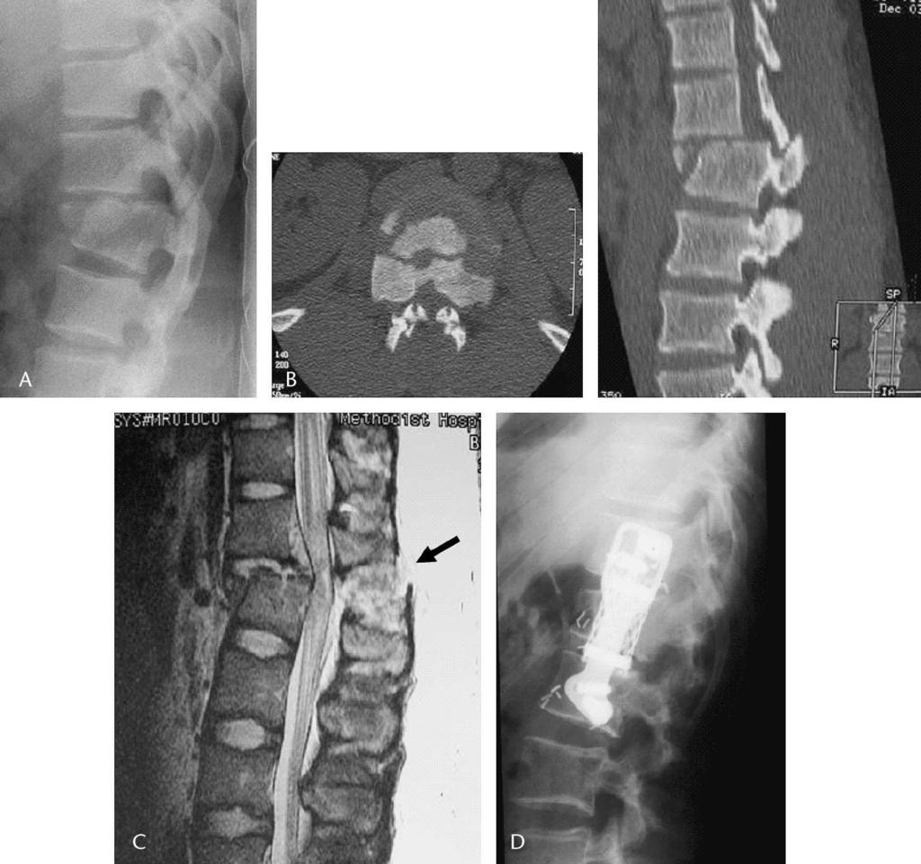 J Spinal Disord Tech Volume 18, Supplement 1, February 2005 Stabilization of Three-Column Thoracolumbar Injuries FIGURE 3. A 33-year-old man with AO type B1.2.3 injury and grade C neurologic deficit.