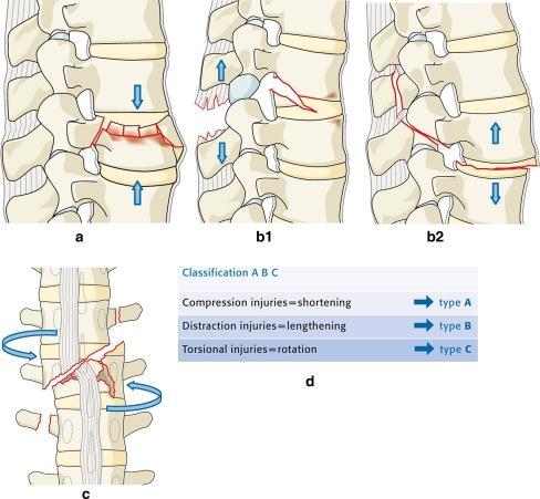 These mechanisms have more or less typical morphological patterns namely socalled compression injuries, distraction injuries and torsional injuries representing shortening,
