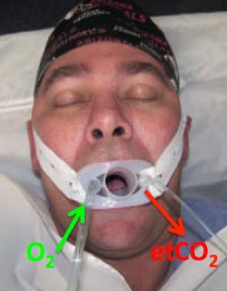 The Hauge Airway provides enough lateral width to maintain the tongue anterior in the oropharynx to ensure
