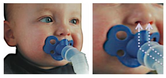 Pacifier. Calms the infant/toddler during aerosol treatment. Medication is inhaled through the nose, not the mouth.