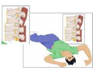 Rotation injuries Occur when the head and body rotate in opposite directions (see Figure 9) Results in twisting of the muscle, ligaments, vertebrae and/or spinal cord Common causes of rotation