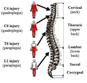 The closer to the head the spinal cord injury is, the greater the area of the body that may be affected.