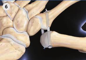 CableFIX Xpress Carpometacarpal Fixation System Operative technique Step 6: Under tension, secure 4 surgeon knots over the 2nd metacarpal 2-hole oblong bone plate.