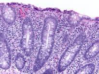 Tufted enteropathy Microscopic Colitis Lymphocytic