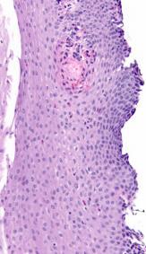 Eosinophilic Crust + Histology rules of thumb GERD <15-20 eos /
