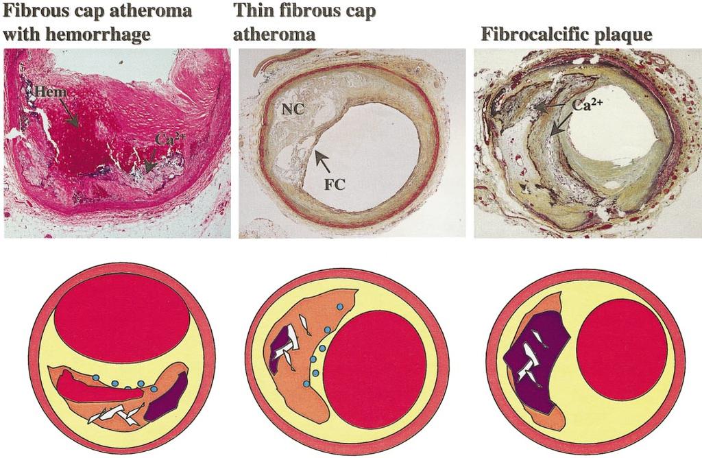 Virmani et al Lesion Classification and Sudden Coronary Death 1269 Figure 5. Variants of fibrous cap atheromas.