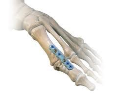 A cut is made over the joint area and the ridges of bone next to the joint and cartilage are removed.