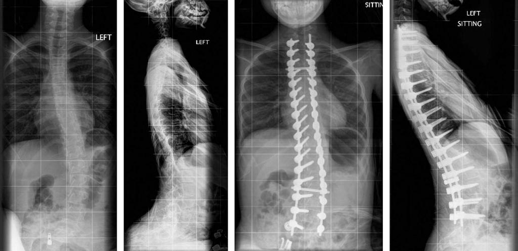 Spinal Deformity Correction in Duchenne Muscular Dystrophy / 45 ple determining the sequence depended on where the initial correcting load needed to be applied.