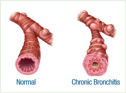 Chronic Bronchitis Occurs when airways become narrow and are partially blocked by mucus