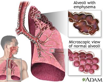Emphysema Occurs when alveolus (air sacs) deform and cannot
