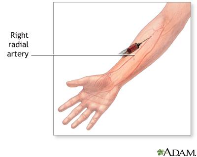 This is a test where a small blood sample is taken from an artery (usually in the wrist)