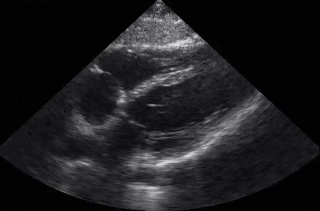 Normal Subxiphoid View Pericardium will be seen as a bright hyperechoic