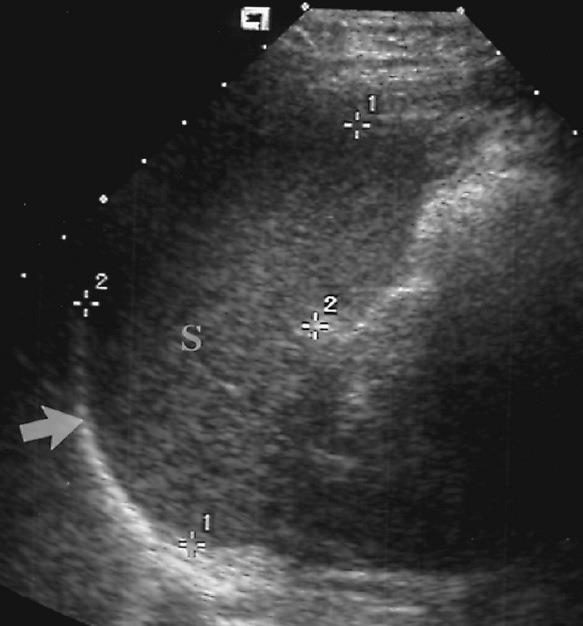 Spleen Spleen has similar texture as the liver Q: What is the arrow pointing to?