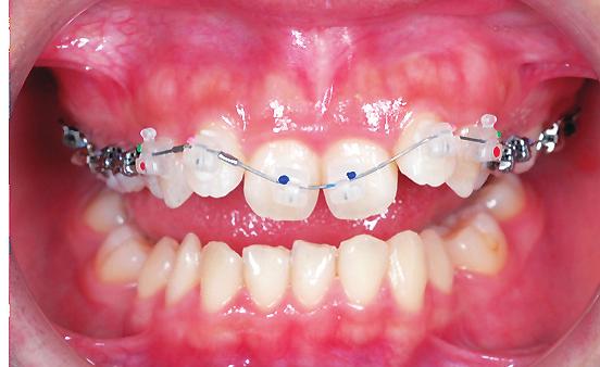 IJOI 35 iaoi CASE REPORT Facial Esthetics: Correct relatively protrusive upper lip, maintain lip competence Other: Correct the gummy smile by improving upper incisor alignment; consider follow-up