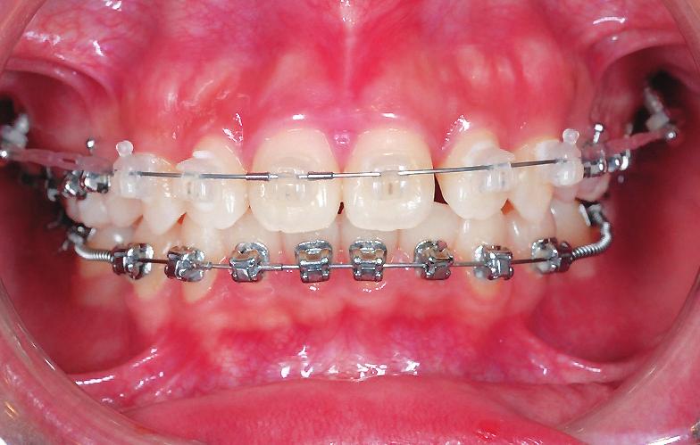 Crowded Class II Division 2 Malocclusion with Class I Molars Due to Blocked In Lower Second Premolars IJOI 35 both arches,