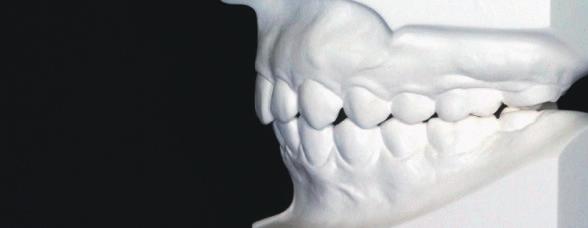 IJOI 35 iaoi CASE REPORT Fig. 2: The occlusal relationships for canines and premolars were still slightly Class II on the finish casts. Fig. 22: The excessive gingival display when smiling was improved and the patient is satisfied with her smile.