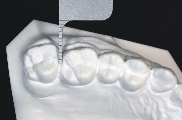 The 4 posterior rotation of the mandible did not compromise the facial profile, but it did require excessive inclination of the lower incisor to correct the overjet.