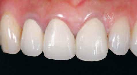 This strong umbrella effect 13 generated by the metal substructure and dark underlying dentin was resolved by the combination of the walking bleach technique, adhesively