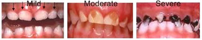 Image Source: Pediatric Dentistry East 3 Oral Disease in California 58% of pregnant women did not receive dental care