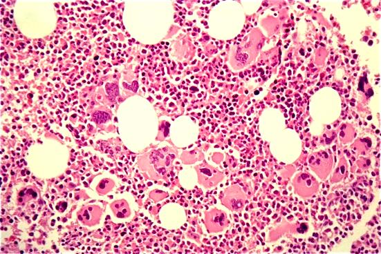 Essential Thrombocythemia Essential thrombocythemia (ET) is a chronic myeloproliferative disorder characterized by panmyelosis, with a megakaryocytic predominance.
