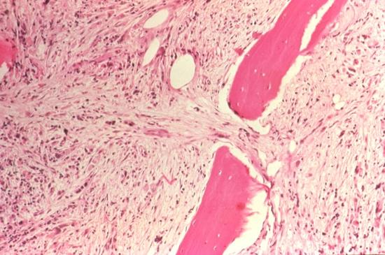 Chronic myelofibrosis Chronic myelofibrosis, also called idiopathic myelofibrosis or agnogenic myeloid metaplasia, is a chronic myeloproliferative disorder characterized by panmyelosis, bone marrow