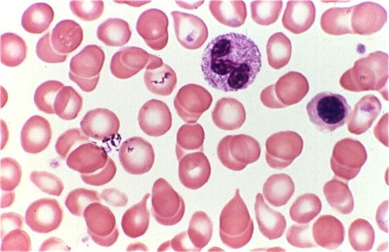 In real words: the bone marrow at first is markedly hypercellular, but over time, it becomes fibrotic, and the hematopoietic cells go elsewhere (most often, to the spleen) to try to make a home.