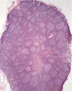cell lymphoma